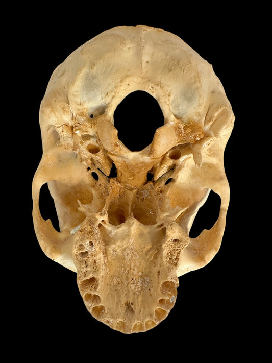 Human Skull Cranium  Autopsy Cut