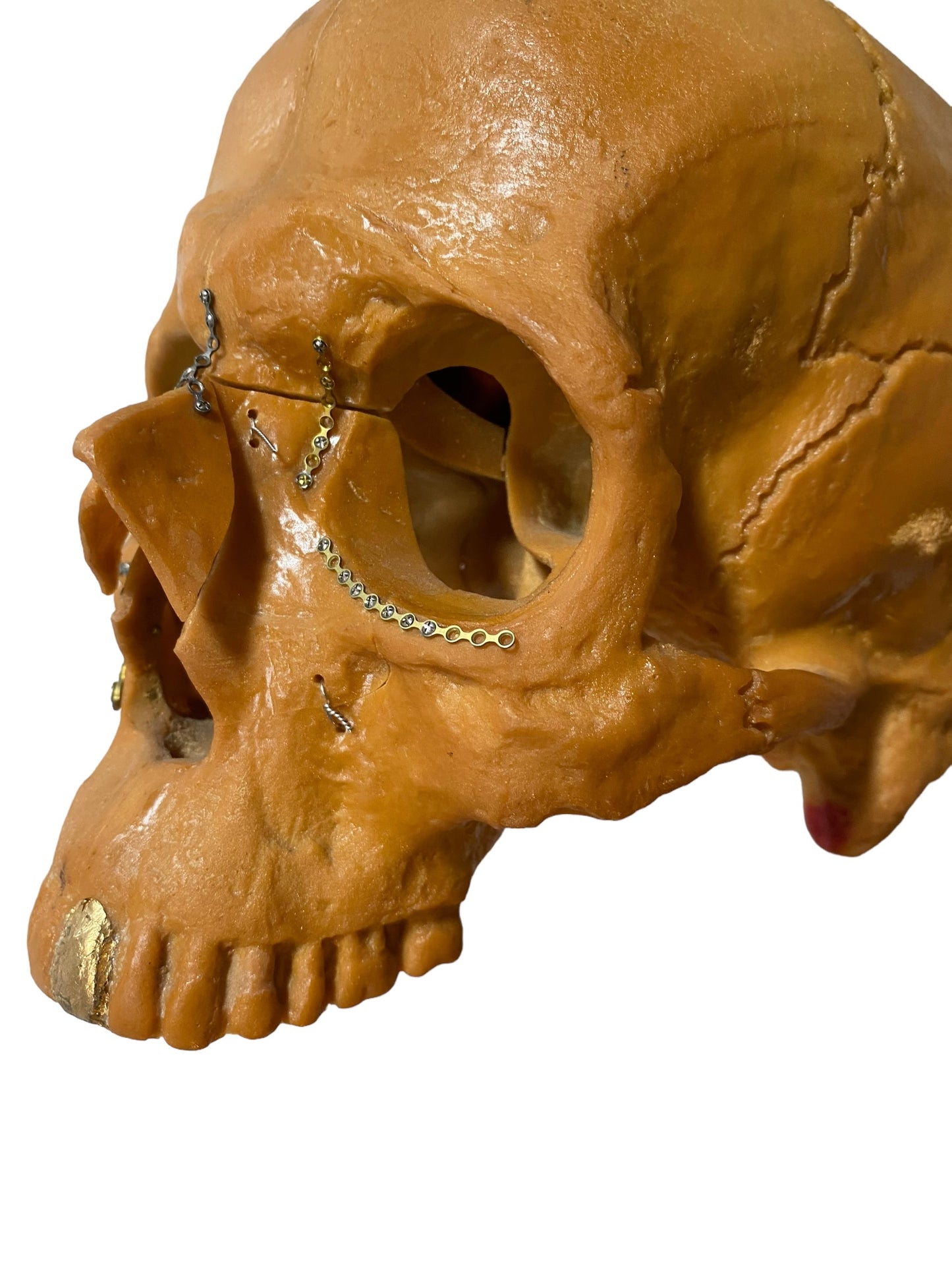 Vtg Facial Reconstructive Medical Model Surgery Skull