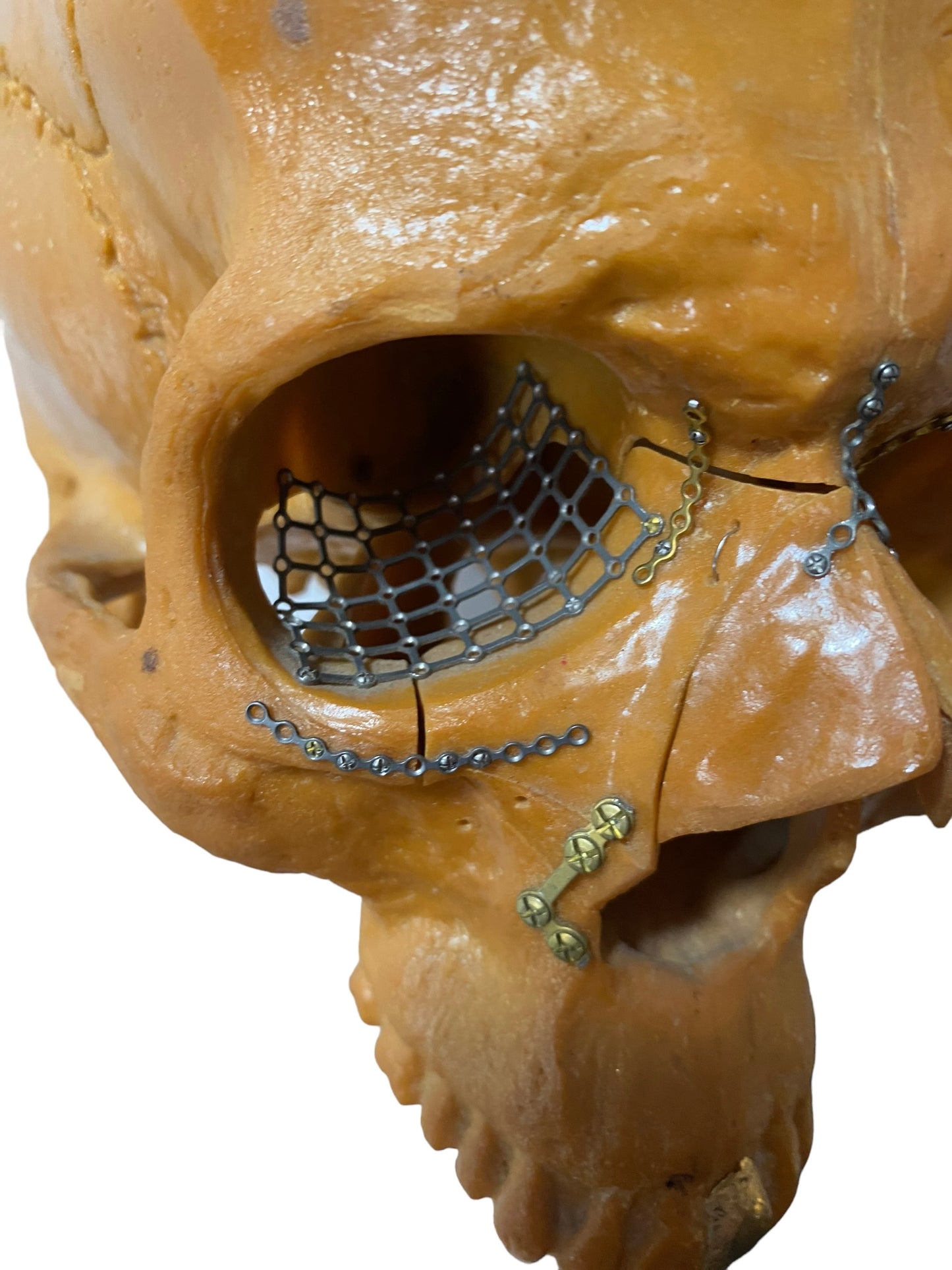 Vtg Facial Reconstructive Medical Model Surgery Skull