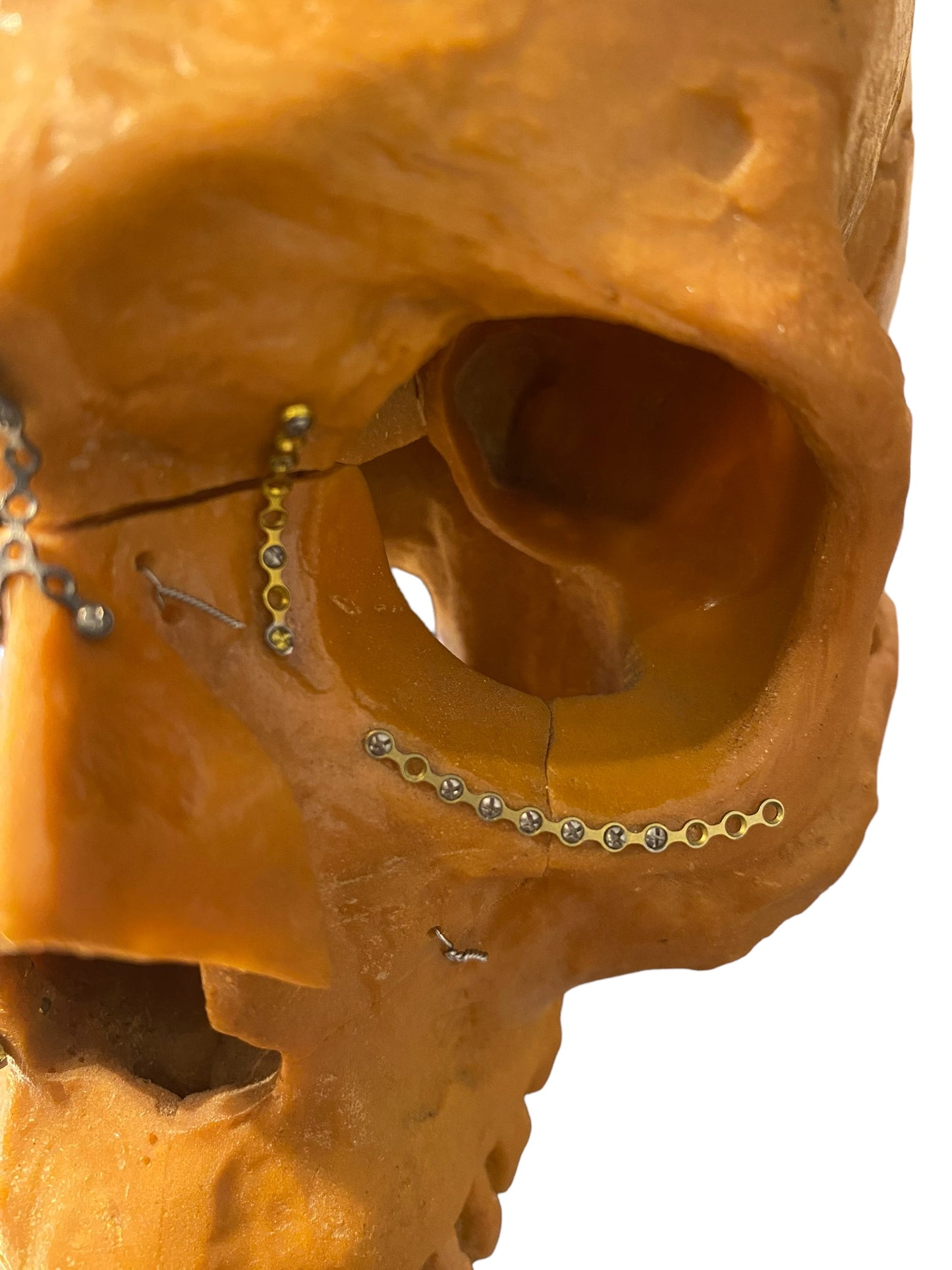 Vtg Facial Reconstructive Medical Model Surgery Skull